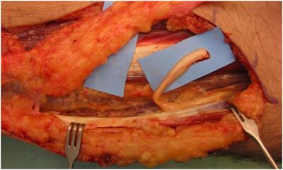Outcome of Stromal Vascular Fraction-Enriched Fat Grafting Compared to Intramuscular Transposition in Painful End-Neuromas of Superficial Radial Nerve: Preliminary Results